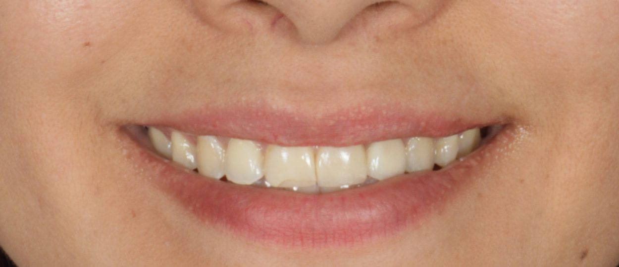 Antes: Carillas