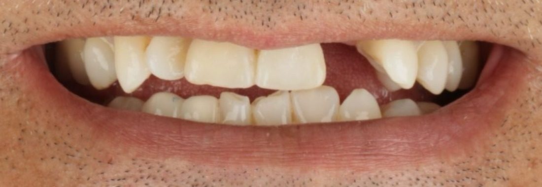 Antes: Implante dental