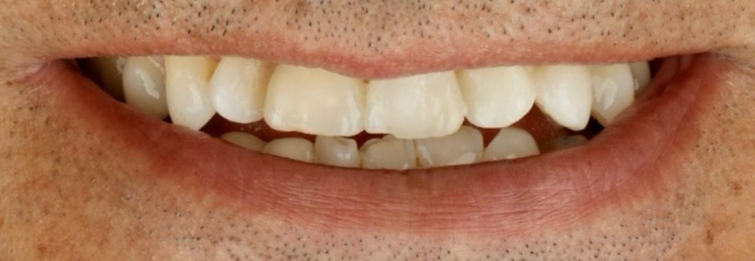 Después: Implante dental